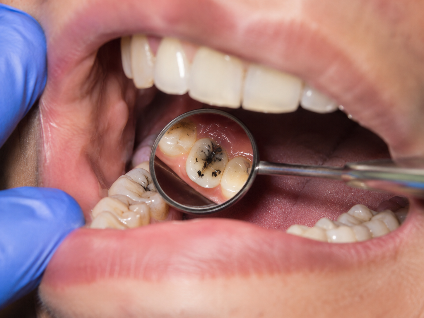 Black spots on teeth showing possible tooth stain, tartar or decay during a dental examination