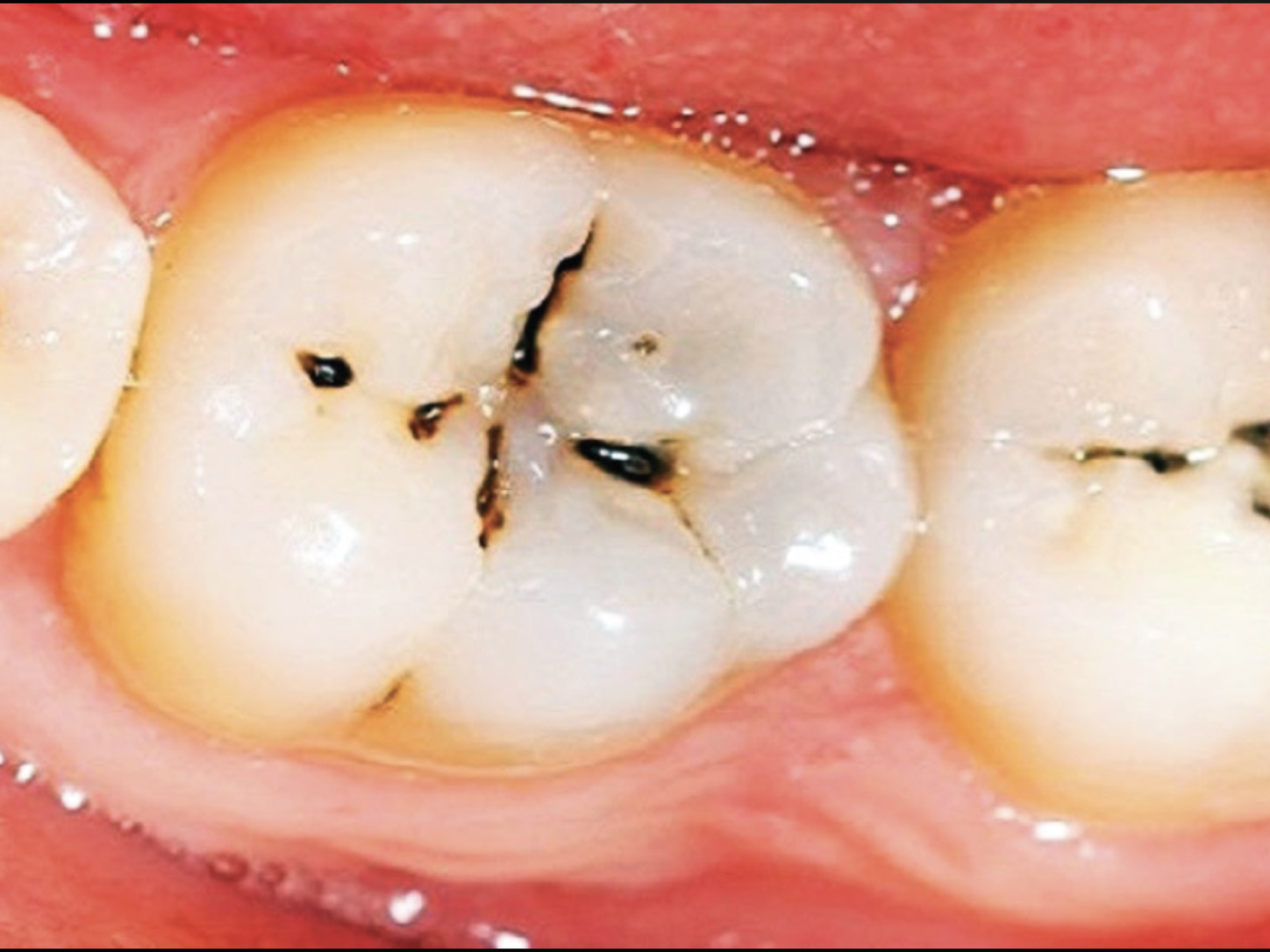 Close-up of molar teeth showing dark decay lines in the grooves, commonly mistaken for tooth worms or keeda in teeth